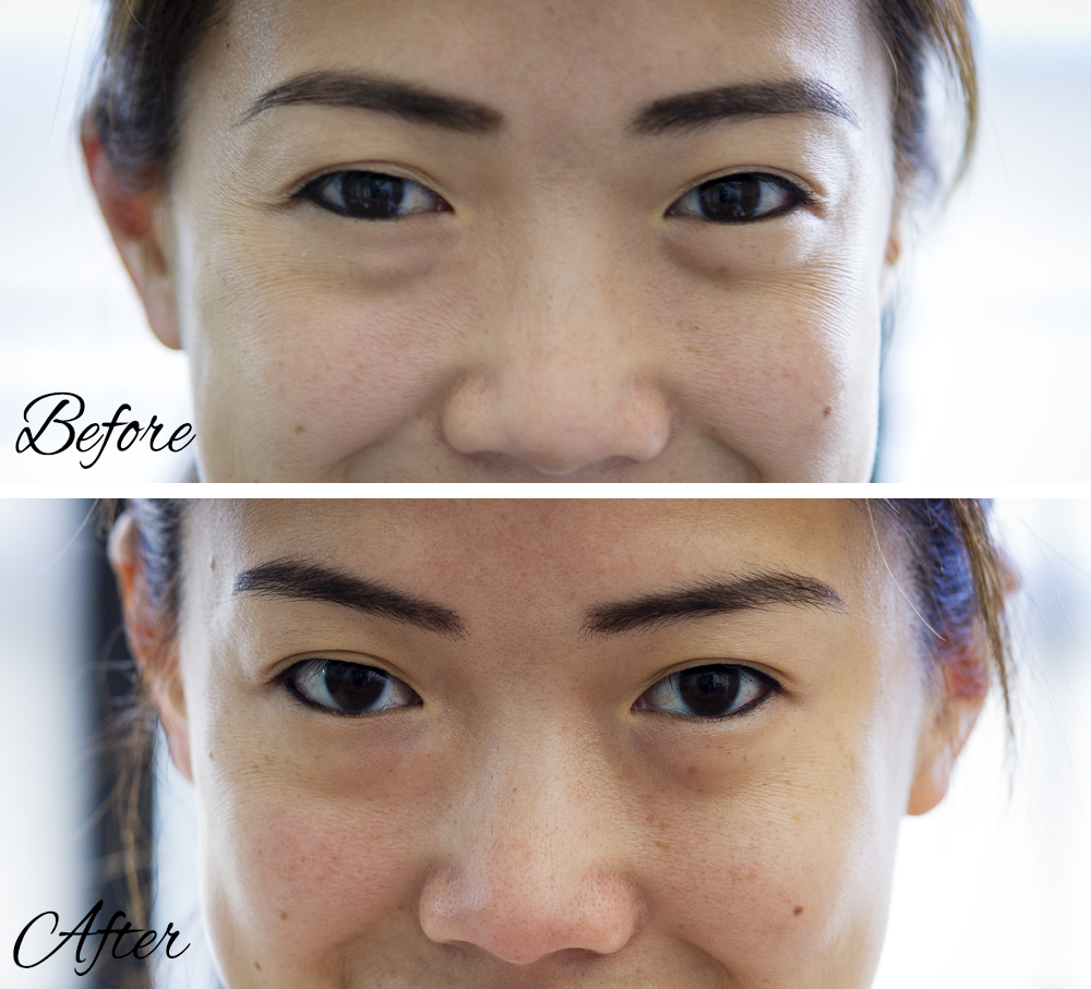 Rodan + Fields Acute and Redefine Skincare: Before and After Results