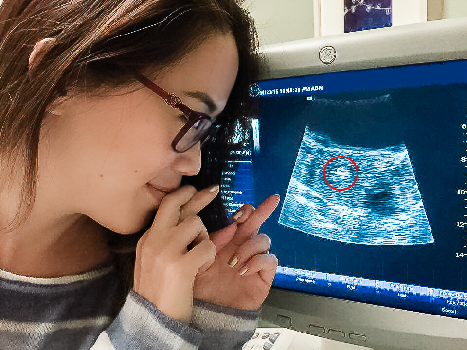 Post-op of having the blastocyst inserted (circled in red on the monitor); fingers crossed that 'she' would stick!